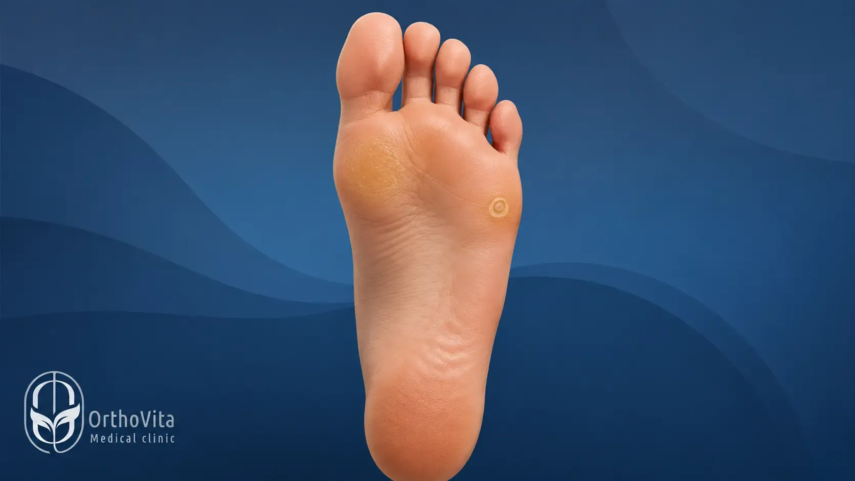 تفاوت ظاهری میخچه موضعی و پینه گسترده در کف پا