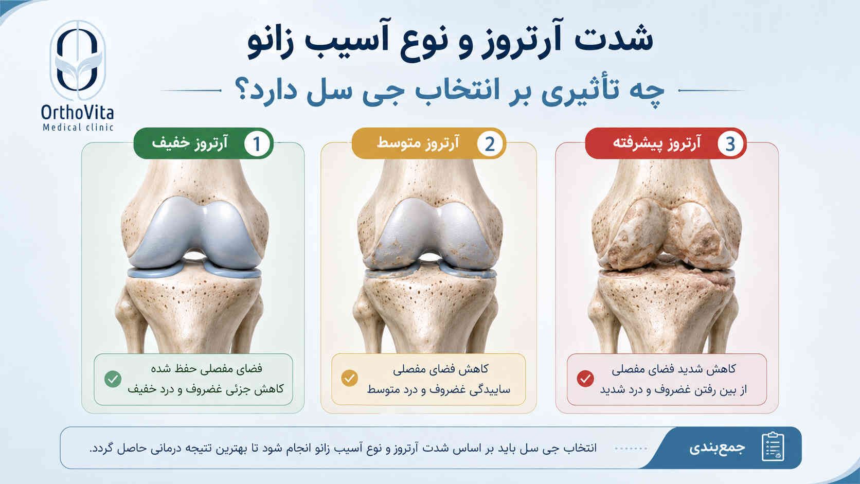 مقایسه آرتروز خفیف، متوسط و پیشرفته برای انتخاب جی سل زانو