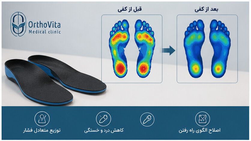 مقایسه توزیع فشار کف پا قبل و بعد از استفاده از کفی طبی سفارشی