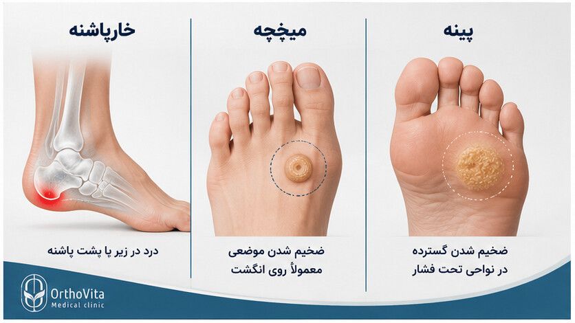 مقایسه تصویری خارپاشنه، میخچه و پینه در بخش‌های مختلف پا