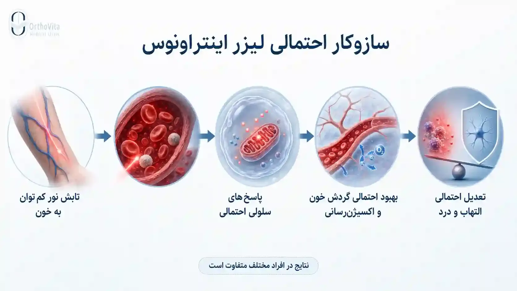 سازوکار احتمالی لیزر اینتراونوس اینفوگرافی سازوکار احتمالی لیزر اینتراونوس و تأثیر آن بر التهاب و درد