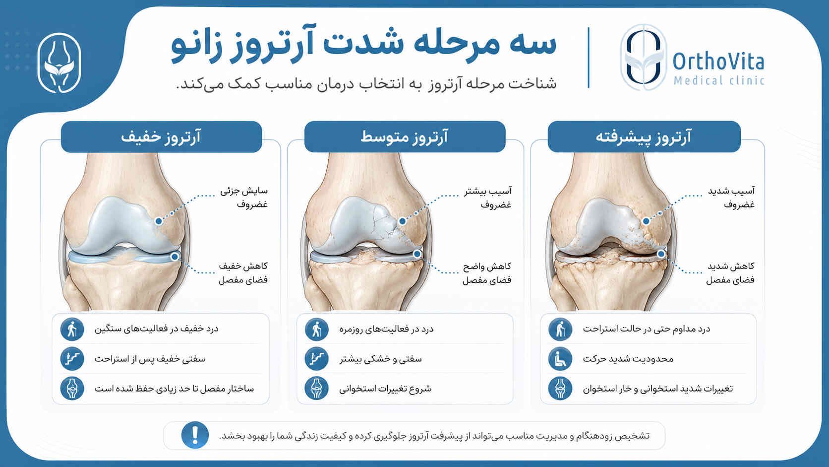اینفوگرافی مقایسه آرتروز خفیف، متوسط و پیشرفته زانو