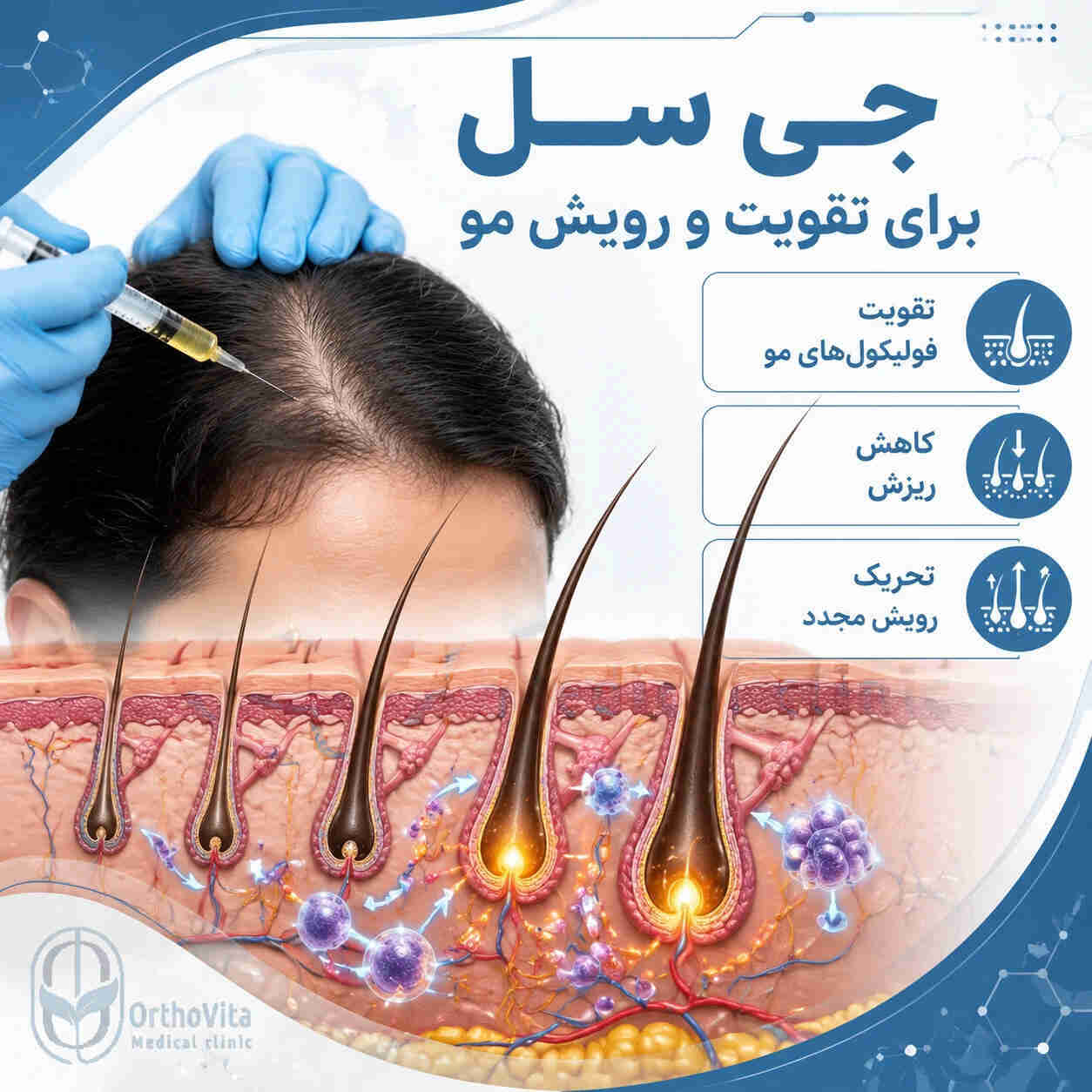 تقویت و جوانسازی پوست با استفاده از تزریق جی سل g-cell