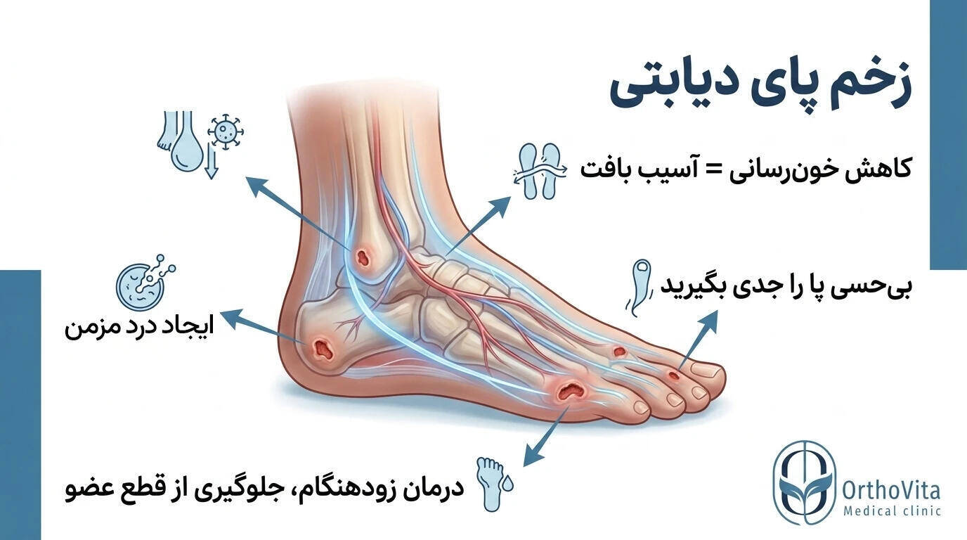 زخم پای دیابتی چیست؛ آشنایی ومعرفی