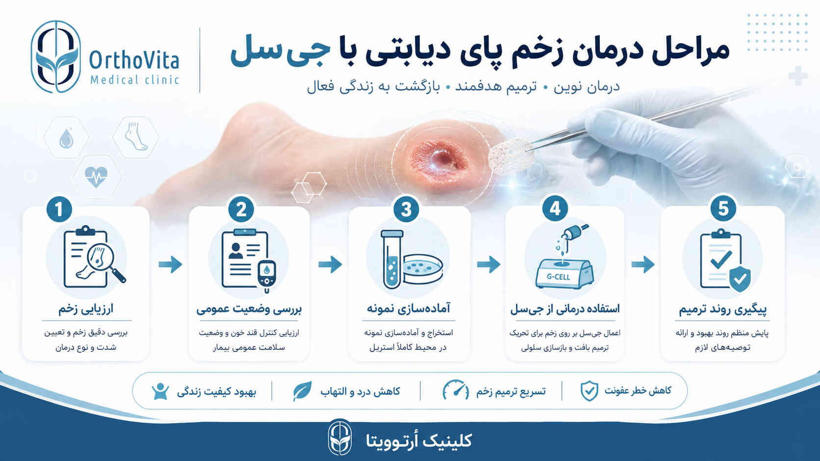 مراحل درمان زخم پای دیابتی با جی‌سل