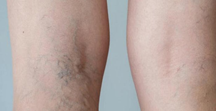 درمان واریس در کلینیک اُرتوویتا