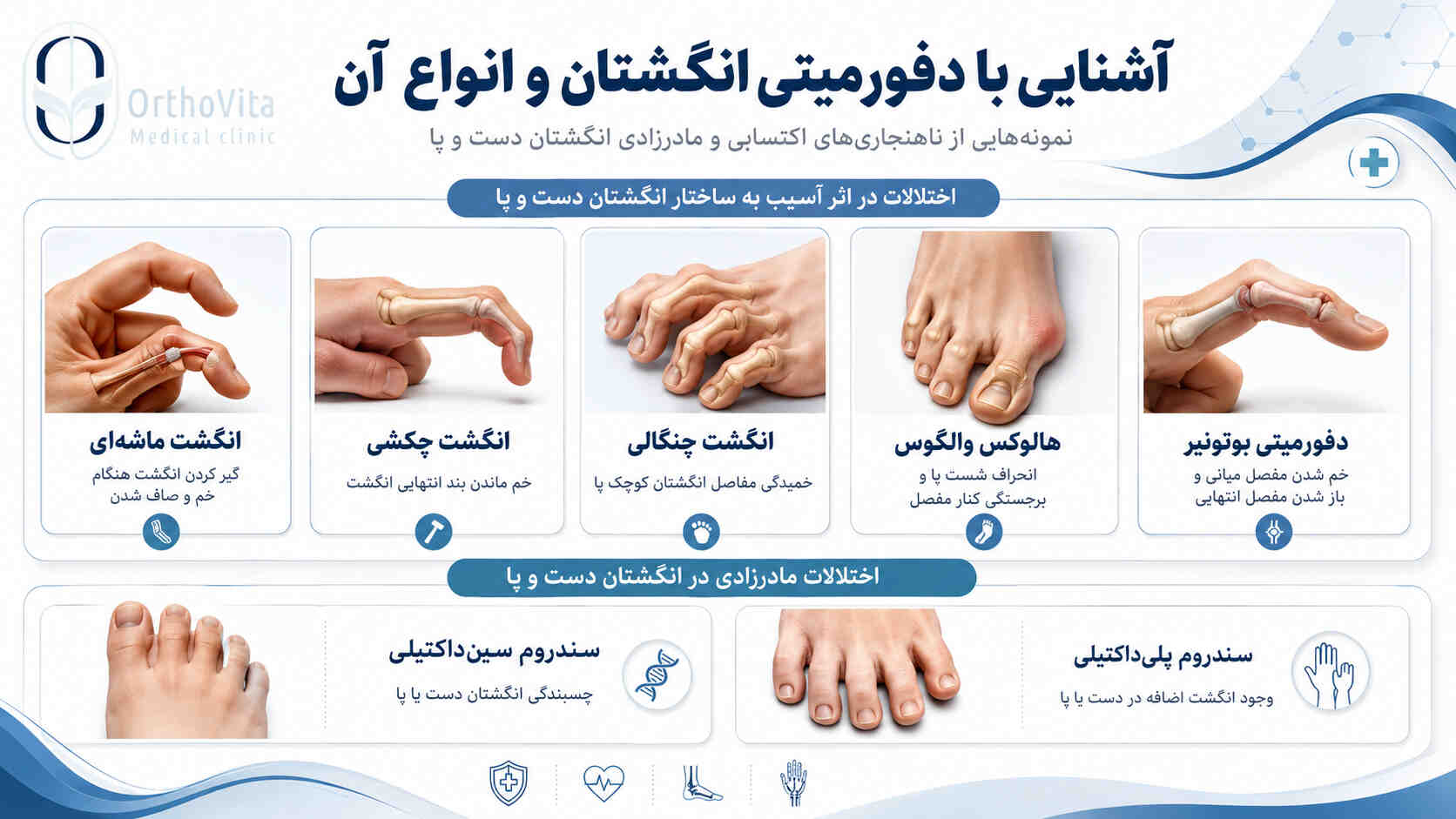 آشنایی باانواع دفرمیتی انگشتان